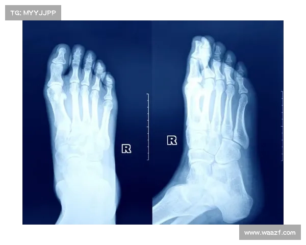 脚部应力性骨折：高大体重球员的常见伤病防治